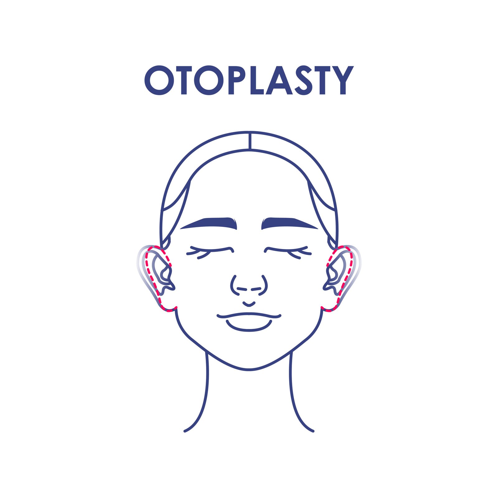 Otoplasty. Ear surgery. Vector illustration of female face. Plastic surgery. For your design